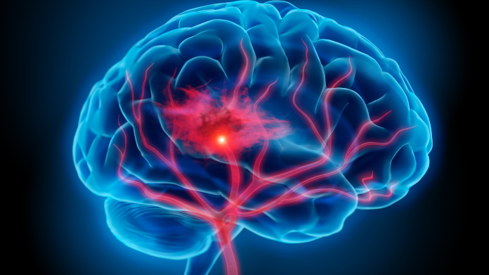 Rottura di vasi sanguigni nel cervello