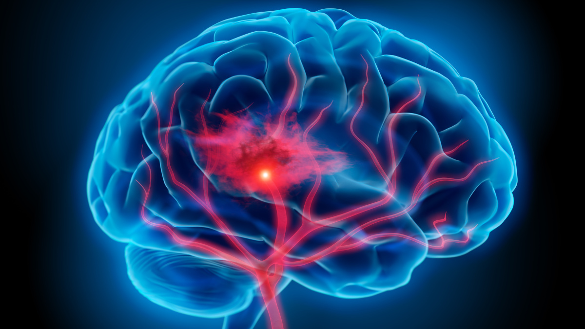 Blood vessel rupturing in the brain