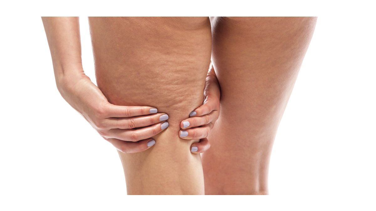 Woman’s leg with cellulite
