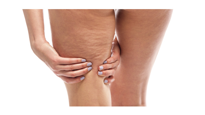 Gamba di donna con cellulite