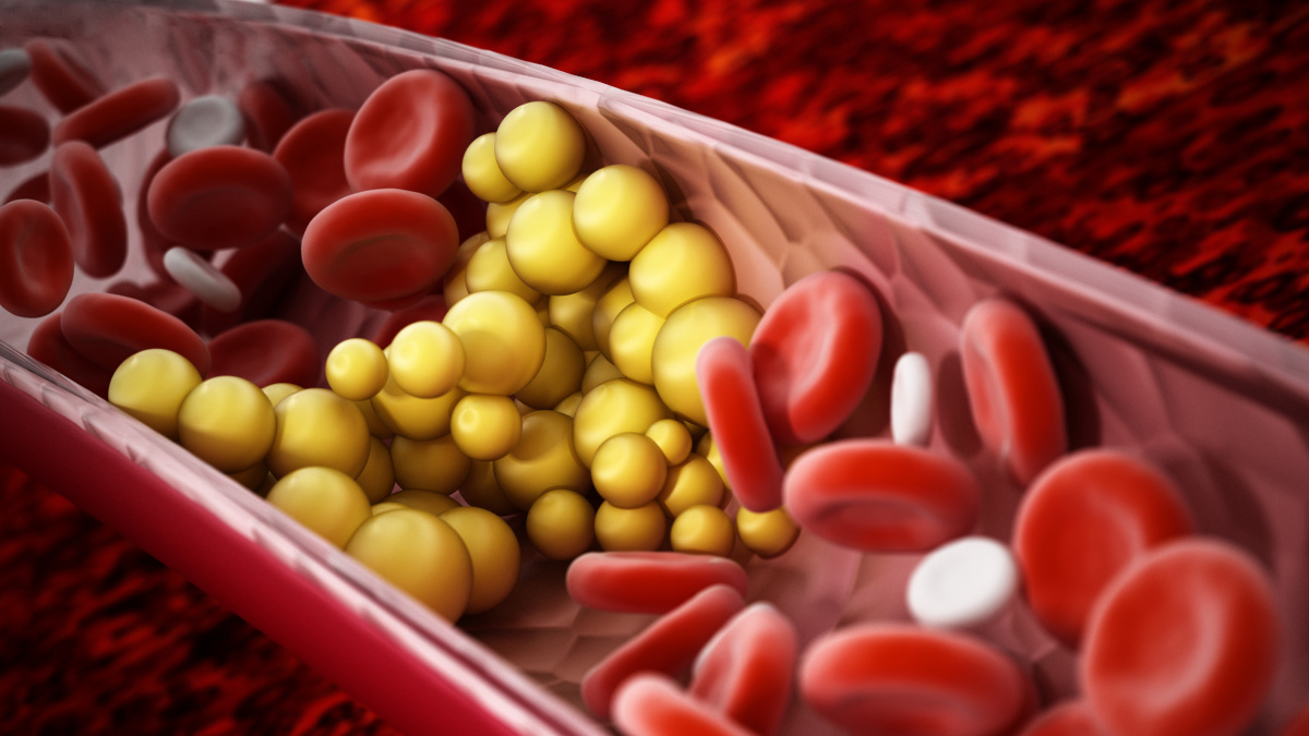 Colesterolo cattivo LDL che ostruisce le arterie