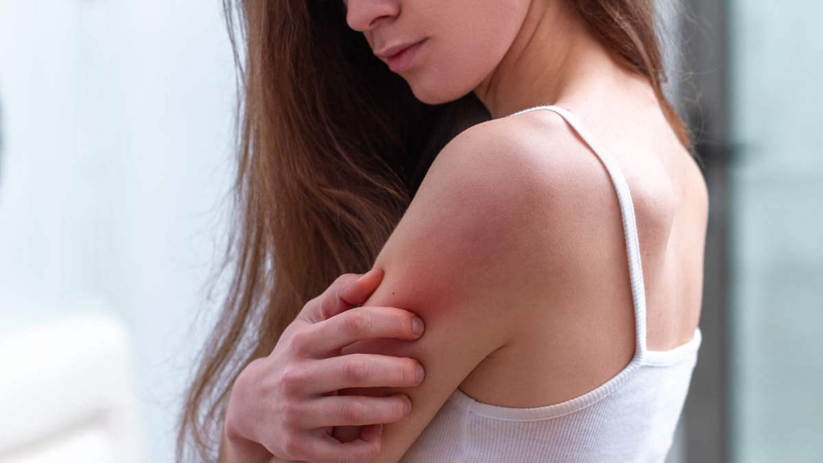 Frau mit atopischem Ekzem kratzt sich am Arm