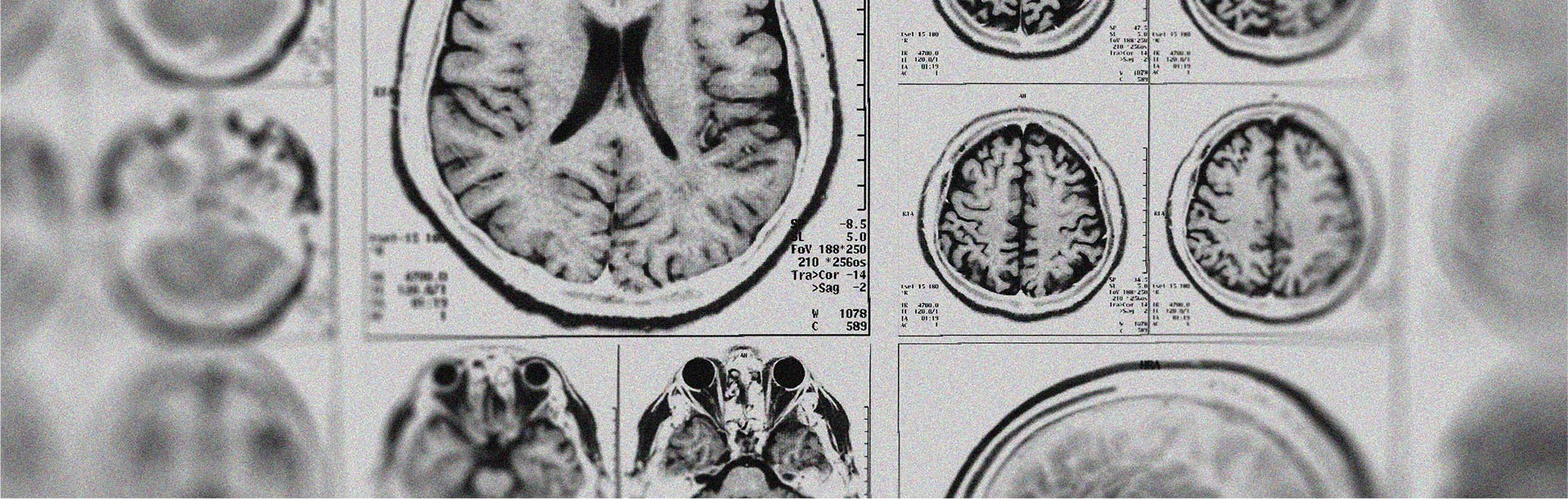 Découvrez si la mélatonine a un effet neuroprotecteur
