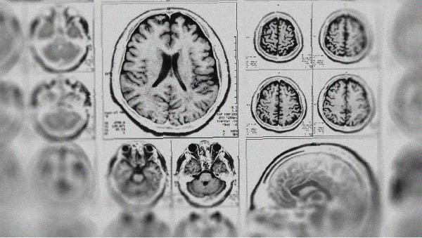 Discover whether melatonin has a neuroprotective effect